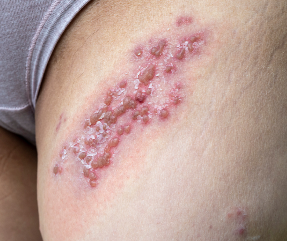 Genital Herpes Treatments at BGS